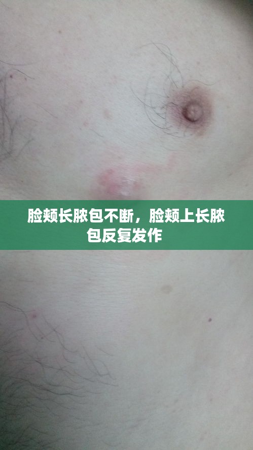 臉頰長膿包不斷，臉頰上長膿包反復(fù)發(fā)作 