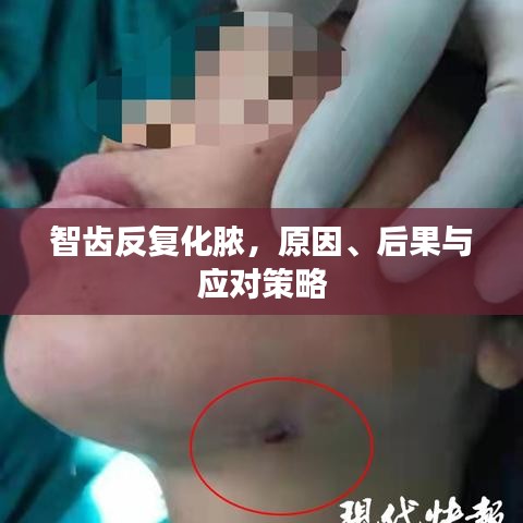 智齒反復化膿，原因、后果與應對策略