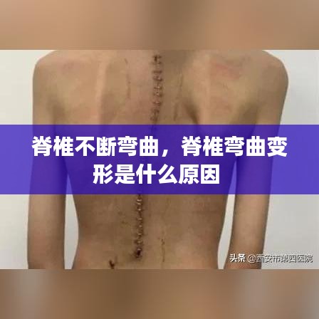 脊椎不斷彎曲，脊椎彎曲變形是什么原因 