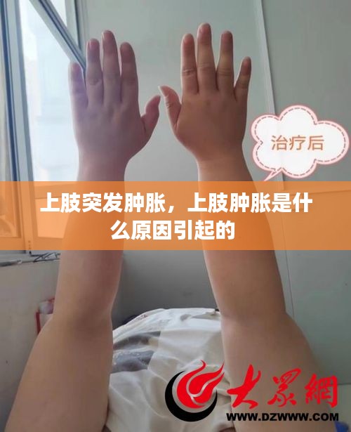 上肢突發(fā)腫脹，上肢腫脹是什么原因引起的 