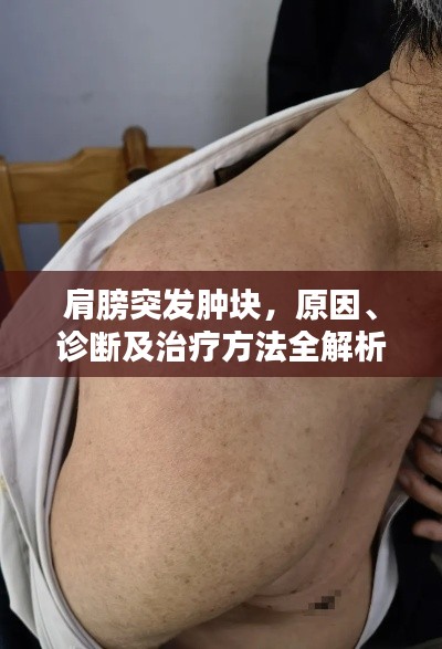 肩膀突發(fā)腫塊，原因、診斷及治療方法全解析