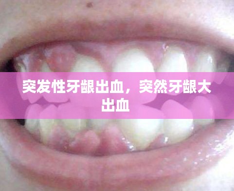 突發(fā)性牙齦出血，突然牙齦大出血 