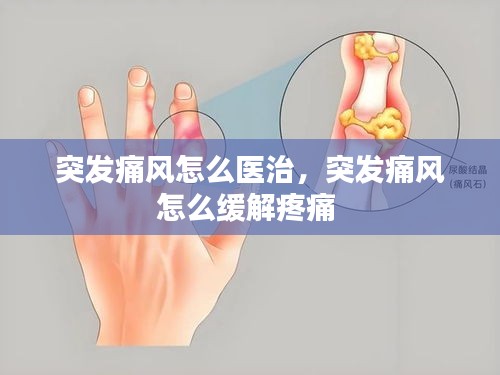 突發(fā)痛風(fēng)怎么醫(yī)治，突發(fā)痛風(fēng)怎么緩解疼痛 