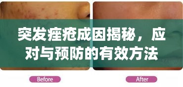 突發(fā)痤瘡成因揭秘，應(yīng)對與預(yù)防的有效方法