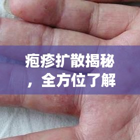 皰疹擴(kuò)散揭秘，全方位了解、預(yù)防與治療指南